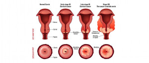 cervical cancer | American Pregnancy Association