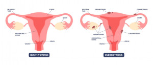 endometriosis-illustration-uterus-fallopian-tube-ovary-cervix-vagina | American Pregnancy Association