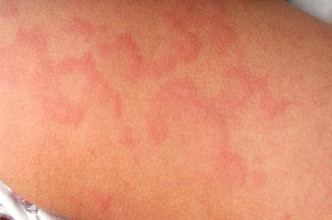 hives-during-pregnancy-close-up-skin-itching-scratching | American Pregnancy Association