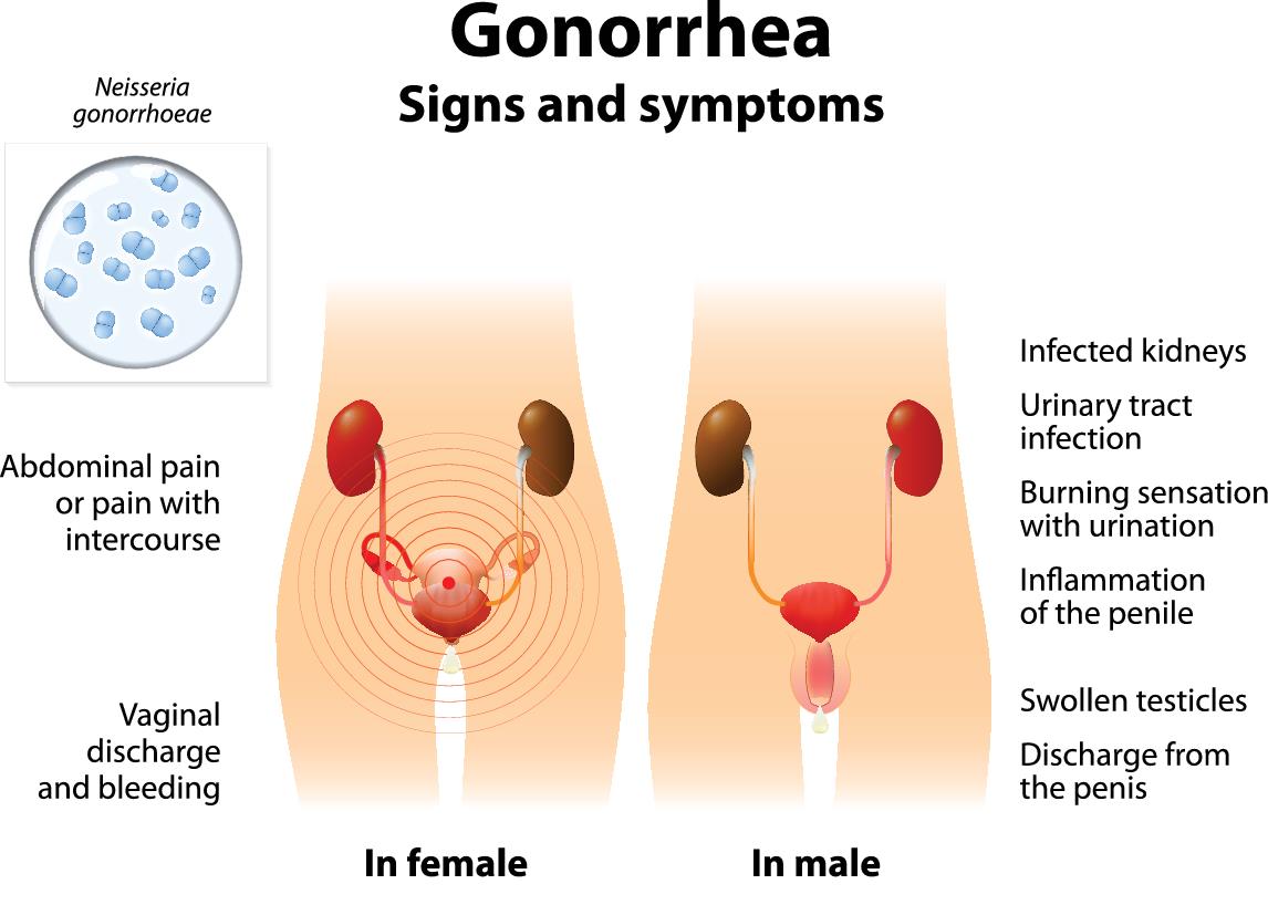 signs-symptoms-gonorrhea | American Pregnancy Association