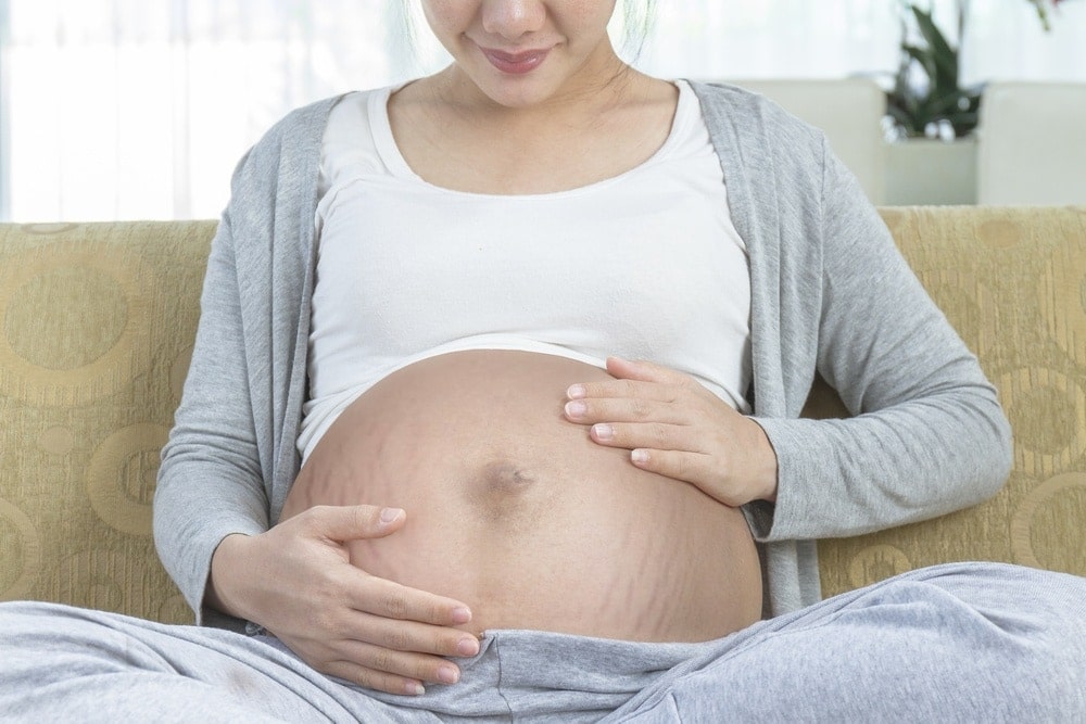 pregnancy-stretch-marks | American Pregnancy Association